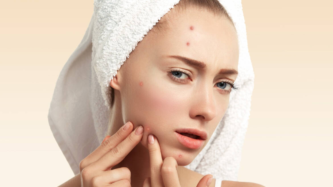 Unlocking the Secrets of Acne Treatment