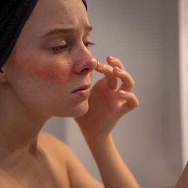 Cupping – The Best Rosacea Redness Treatment Choice