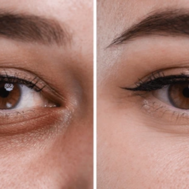 How Often Should You Get Dark Circle Laser Treatments for Maximum Results?