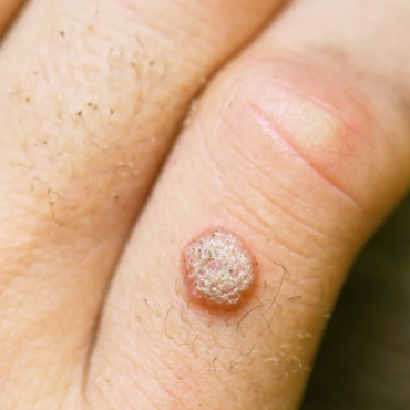 Are Wart Removal Treatments Safe? A Guide to Safe and Effective Solutions at Halina The Cupping Clinic, Chennai