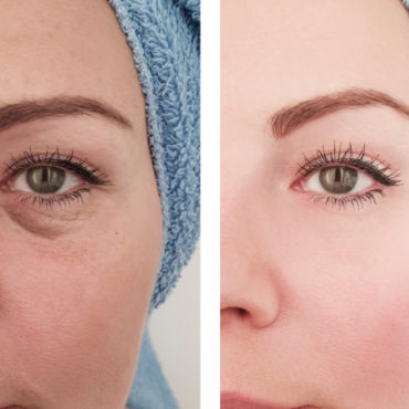 Are Dark Circle Treatments Suitable for All Skin Types?