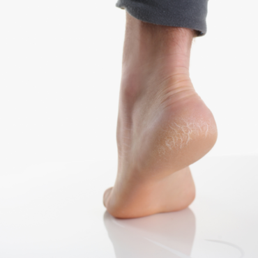 Say Goodbye to Cracked Heels: How Advanced Foot Reflexology Pedicures Help Heal Your Feet at Halina The Cupping Clinic, Chennai