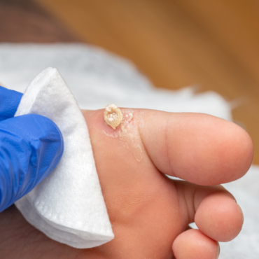 What to Expect During a Professional Wart Removal Treatment at Halina The Cupping Clinic, Chennai