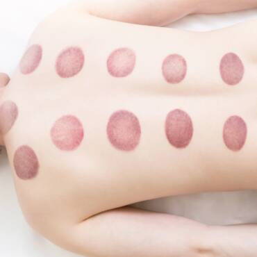 What Those Purple Marks Really Mean After a Cupping Session