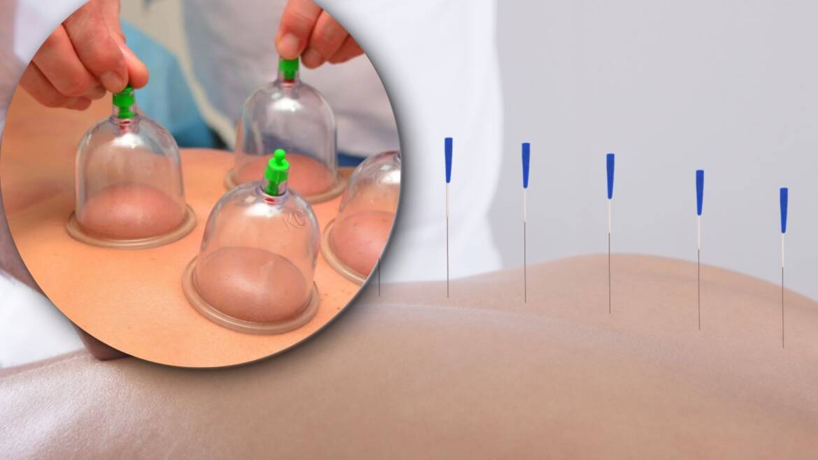 What Is Acupuncture and How Does It Compliment Cupping Therapy?