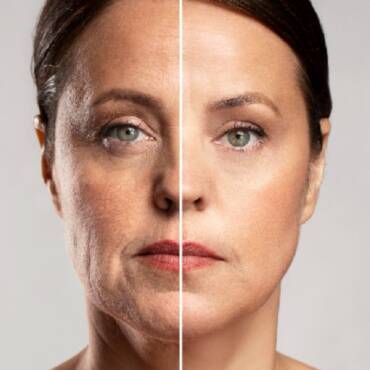 HydraFacial Anti-Aging Treatment: Reverse Fine Lines and Wrinkles Naturally